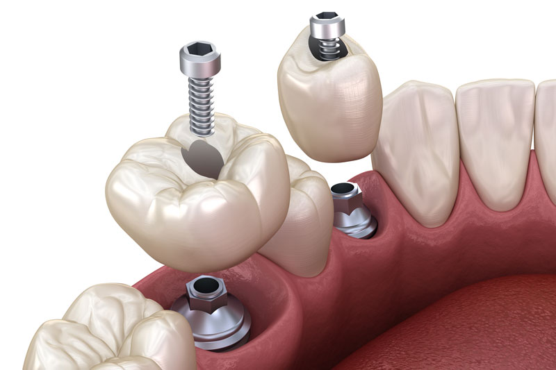 2 single dental implants with crowns on top