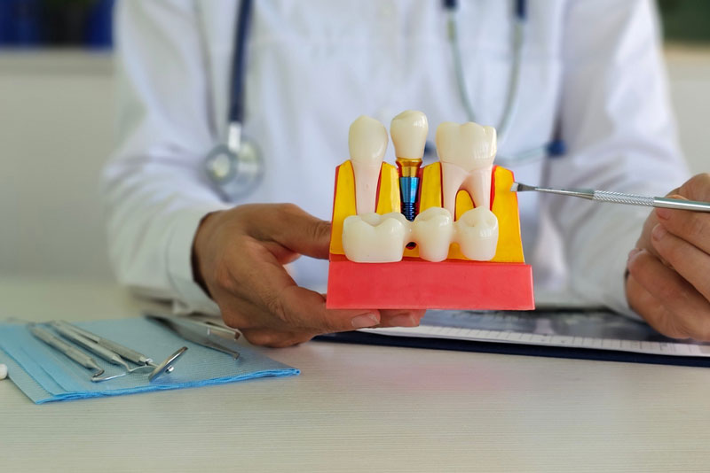 Dentist holding a dental implant model to explain tooth replacement options—highlighting modern implant dentistry for restoring missing teeth with precision.
