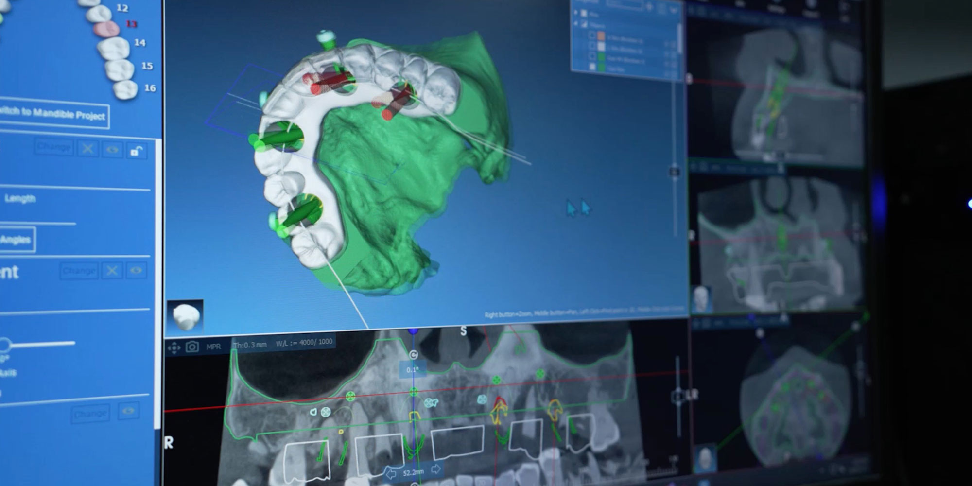 X-rays and implants planning on computer screen